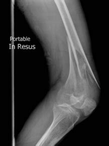 Distal femoral fracture - Physiopedia