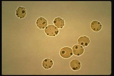 Glucose-6-phosphate dehydrogenase deficiency - Cancer Therapy Advisor