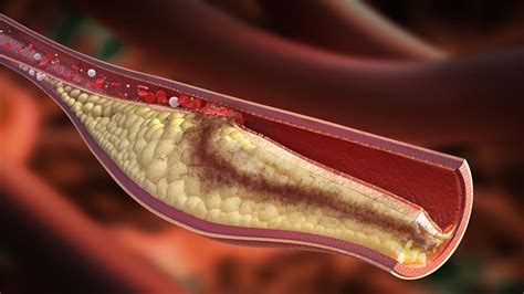 Is coronary plaque regression possible? - Mayo Clinic