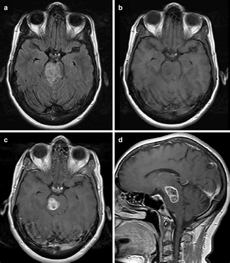 1 Midbrain and pontine high-grade glioma. (a) Fluid-attenuated... | Download Scientific Diagram