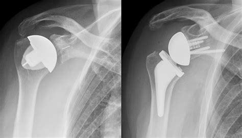 Patients Undergoing Anatomic Total Shoulder Arthroplasty Achieve Clinically Significant Outcomes ...