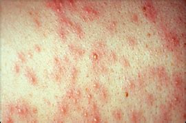 Sepsis Rash Images