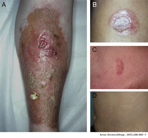 Necrobiosis Lipoidica Diabeticorum African American