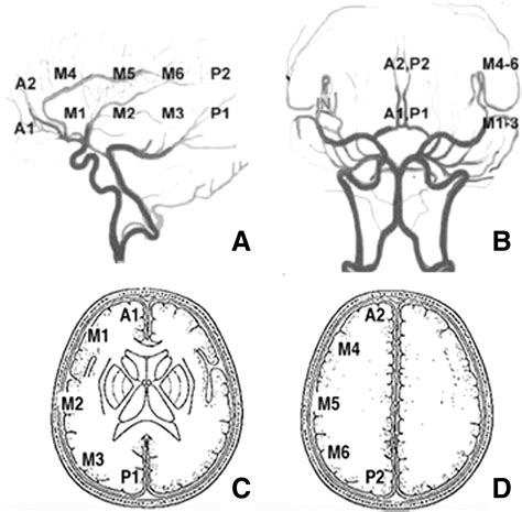 REPERFUSION SCALE,TICI,STROKE,ENDOVASCULAR | hubstroke.com