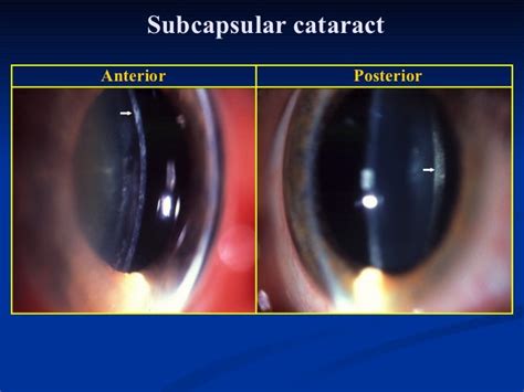 ophthalmology.Diseases of the lens.(dr.baxtyar)