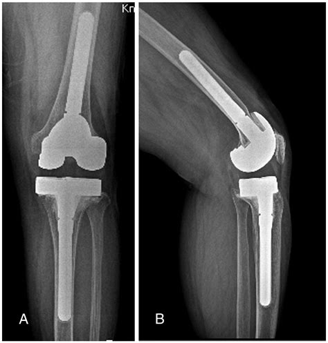 Revision Total Knee Arthroplasty Using a Constrained Condylar Knee Prosthesis in Conjunction ...