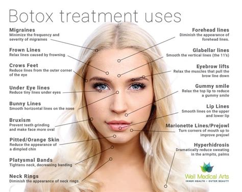 Resultado de imagen para botox injection sites diagram Botox Brow Lift, Eyebrow Lift, Botox ...