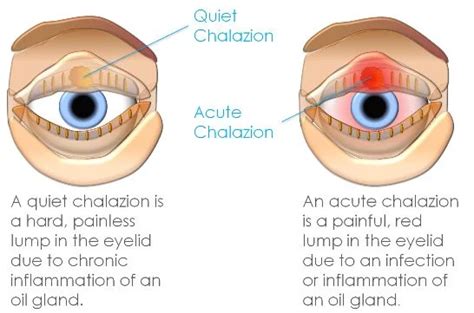 Meibomian Cyst Vs Chalazion