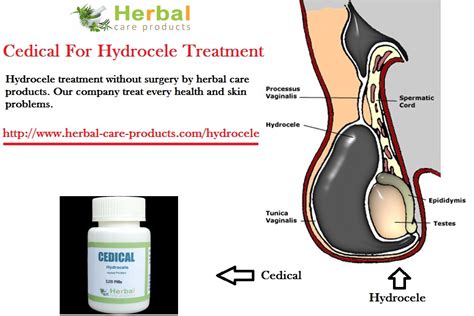 Hydrocele Types