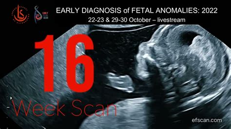 16 Week Anomaly Scan - EARLY DIAGNOSIS of FETAL ANOMALIES 2022 - YouTube