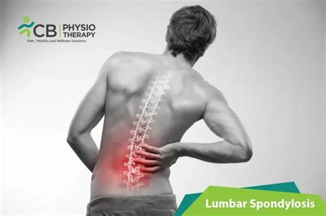 What Is Lumbar Spondylosis?, Symptoms, Causes, Diagnosis & Physiotherapy Treatment Of Lumbar ...