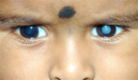 PHFI CEHJ » Common eye diseases in school going children