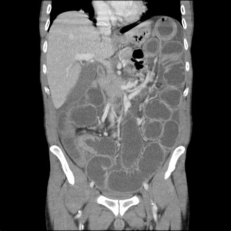 53 Intestine: Tuberculosis | Maude Abbott Medical Museum - McGill ...