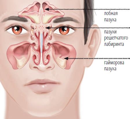 Ways of maxillary sinus cyst natural treatment. - All information about ...