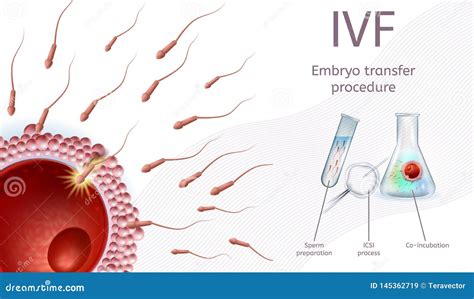 IVF Embryo Transfer Royalty-Free Stock Image | CartoonDealer.com #73449832