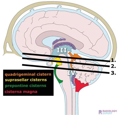 CT brain hemorrhage