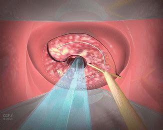 Loop Electro-Excision Procedure (LEEP) | SpringerLink