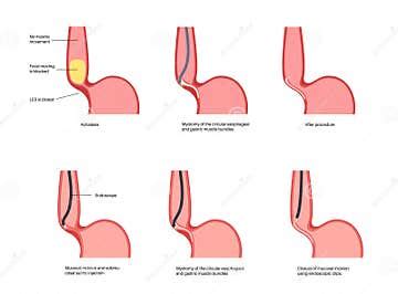 POEM medical poster stock illustration. Illustration of minimally - 290867049