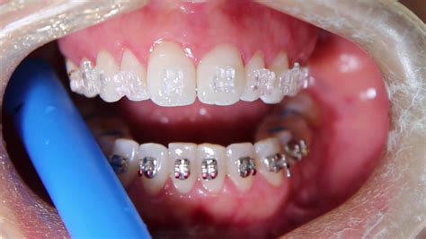 Clear Ceramic Braces - YouTube