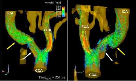 The carotid artery bifurcation of a patient with moderate internal ...