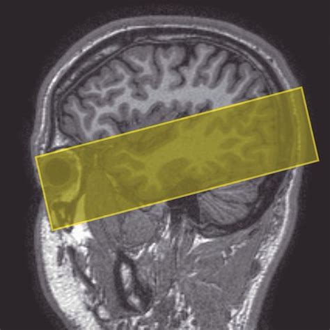 Axial oblique imaging of the temporal lobes. Slices are angled parallel to the temporal lobe ...