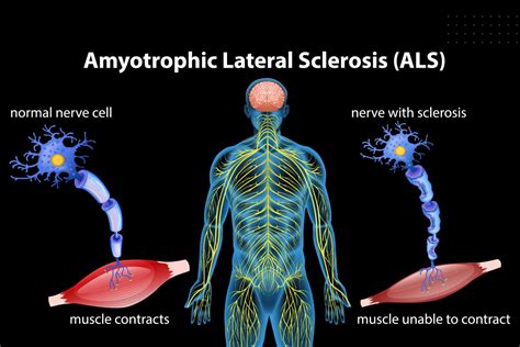 ALS Symptoms, Stages and Progression - Lone Star Neurology