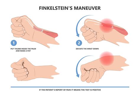 De Quervain's Tenosynovitis | Complete Physio