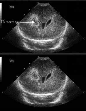 Intraventricular Hemorrhage Neonatal