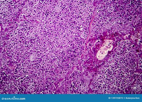 Mycobacterium Tuberculosis Granuloma