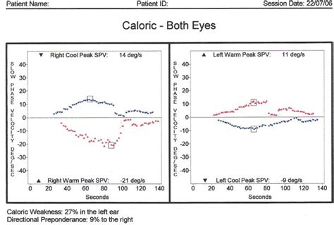 Caloric Test VENG ENG