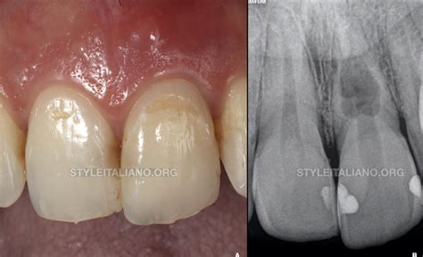 Management of a perforating internal inflammatory root resorption in a maxillary central incisor ...