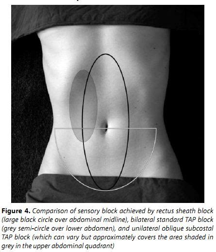 Rectus sheath block +/- catheter | Student Doctor Network