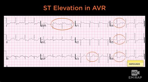 HD - ECG in Pulmonary Embolism | EM:RAP