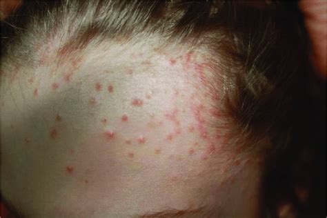 Clobetasol propionate shampoo-induced acne in a 14-year-old girl with... | Download Scientific ...