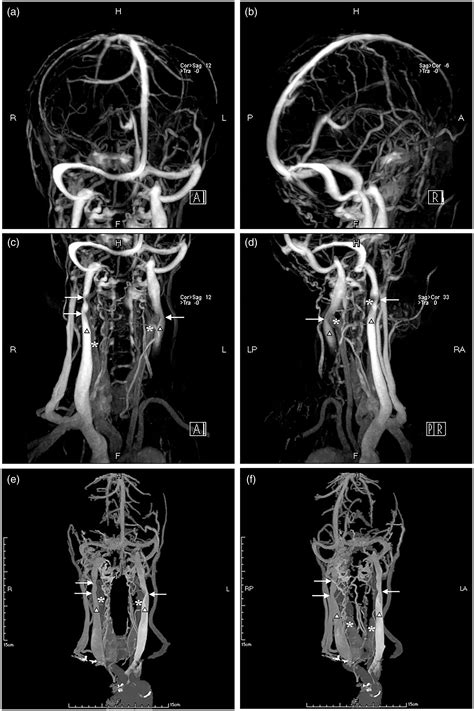 Internal jugular vein stenosis induced by tortuous internal carotid ...