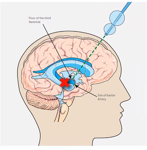 Treatment Endoscopic Third Ventriculostomy (ETV) - hydroandme