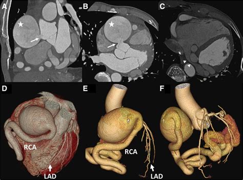 Multimodality Imaging of Giant Right Coronary Aneurysm and Postsurgical ...