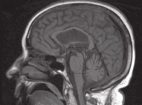 Normal Sagittal Brain Mri