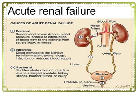 Acute renal failure - Sure Developers Team