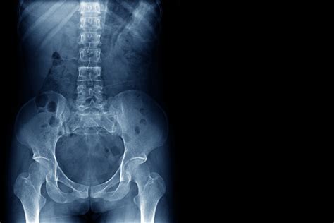 What Is Spinal Fusion Surgery? | PainScale