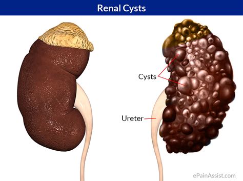 What Size Is A Large Kidney Cyst