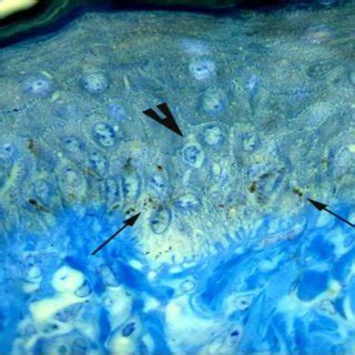 A photomicrograph showing the high amount of melanin granules (arrows)... | Download Scientific ...