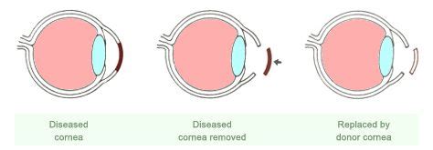 Know about Corneal Blindness and Eye Donation | Medchrome