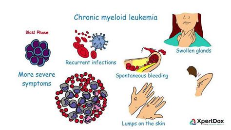 Chronic Myeloid Leukemia - MEDizzy