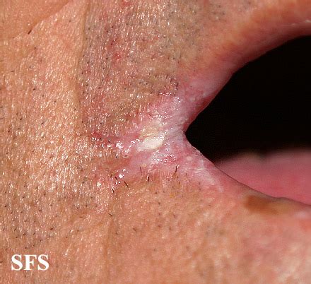 Angular cheilitis - wikidoc