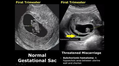 Uterus Ultrasound Normal Pregnancy Vs Miscarriage Image Appearances | Intrauterine Pregnancy USG ...