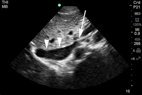 IVC Images | Emergency Ultrasonography