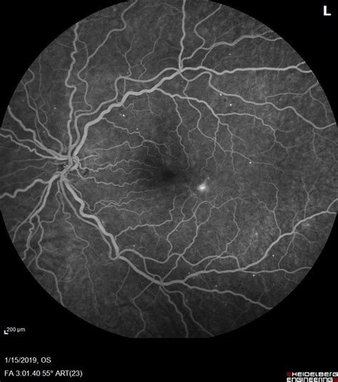 Mild Nonproliferative Diabetic Retinopathy - Retina Image Bank