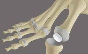 Great Toe Replacement with Synthetic Cartilage | Advanced Orthopaedics & Sports Medicine ...