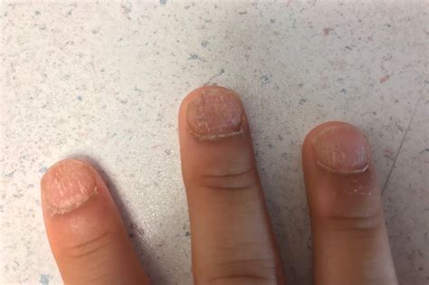 Nail Dystrophy With Ridging and Roughness - Clinical Advisor